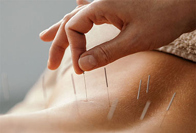 Acupuncture Therapy