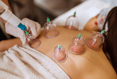 Cupping Therapy<