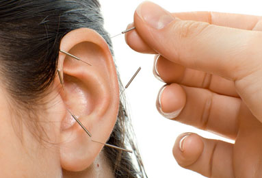 Auricular Acupuncture